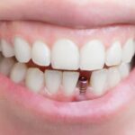 تاثیر سیگار بر شکست درمان ایمپلنت دندان کودکان