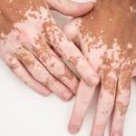 قرصی جدید برای بازگشت رنگ پوست مبتلایان به پیسی