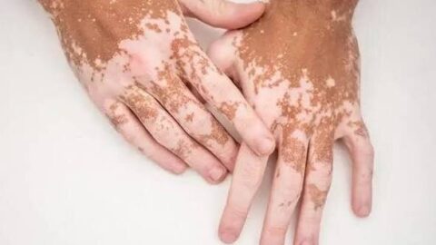 قرصی جدید برای بازگشت رنگ پوست مبتلایان به پیسی